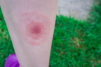 Lyme Disease Rash